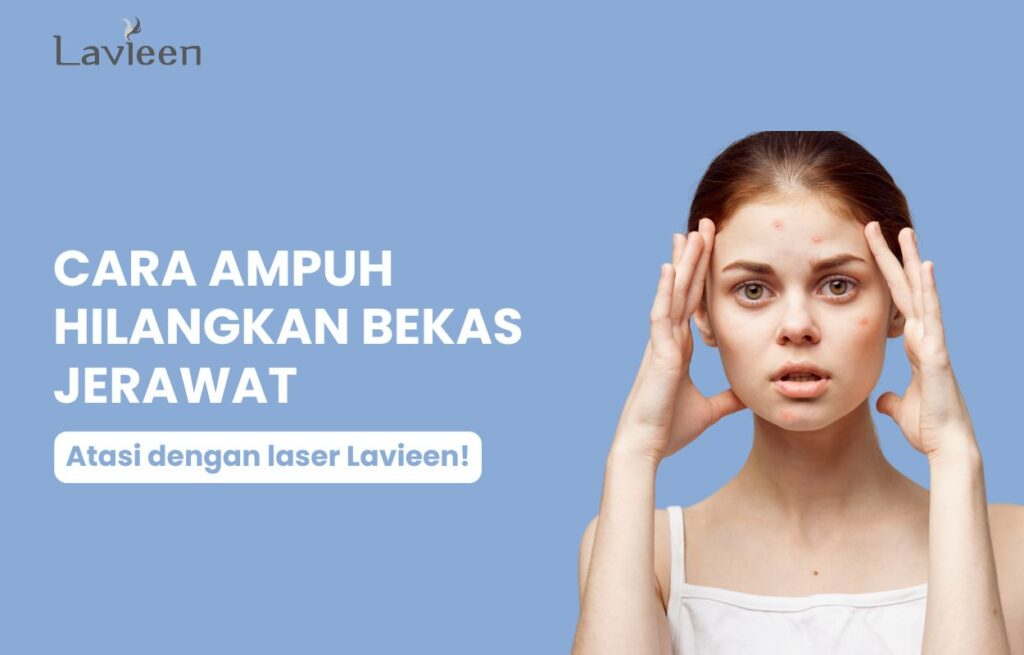 cara hilangkan bopeng bekas jerawat