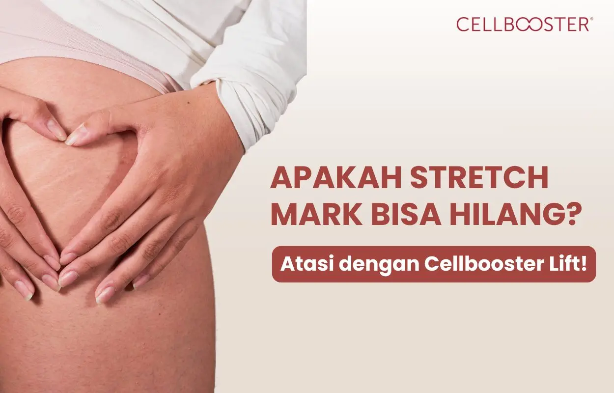 apakah stretch mark bisa hilang