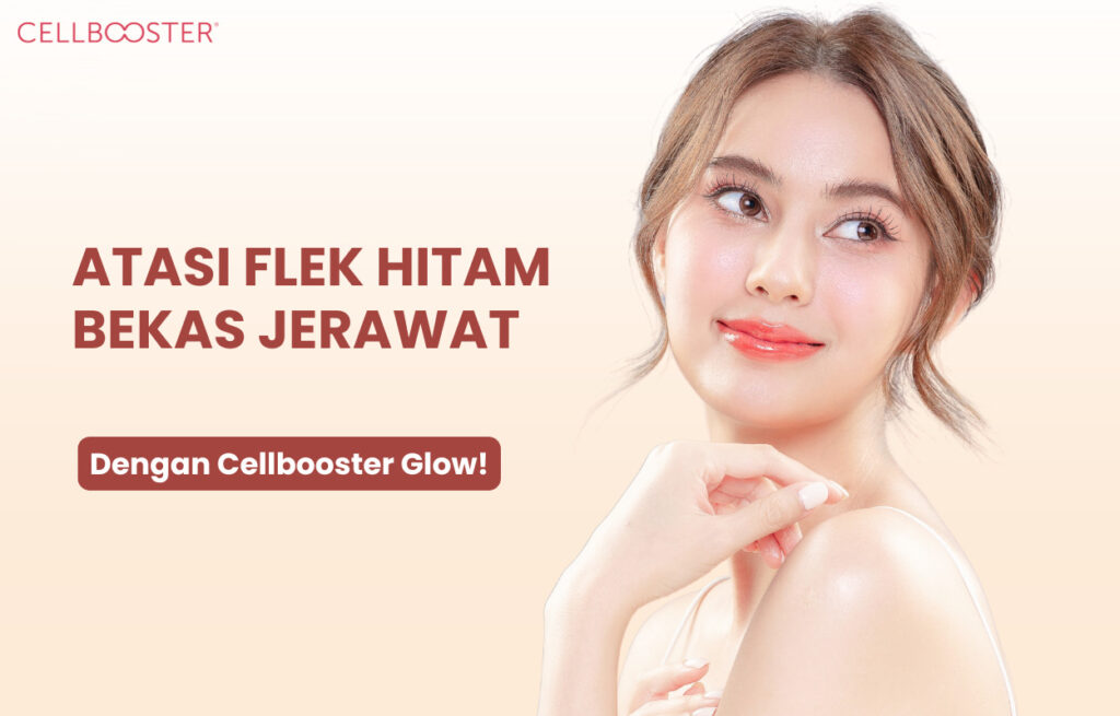 Cara Menghilangkan Flek Hitam Bekas Jerawat