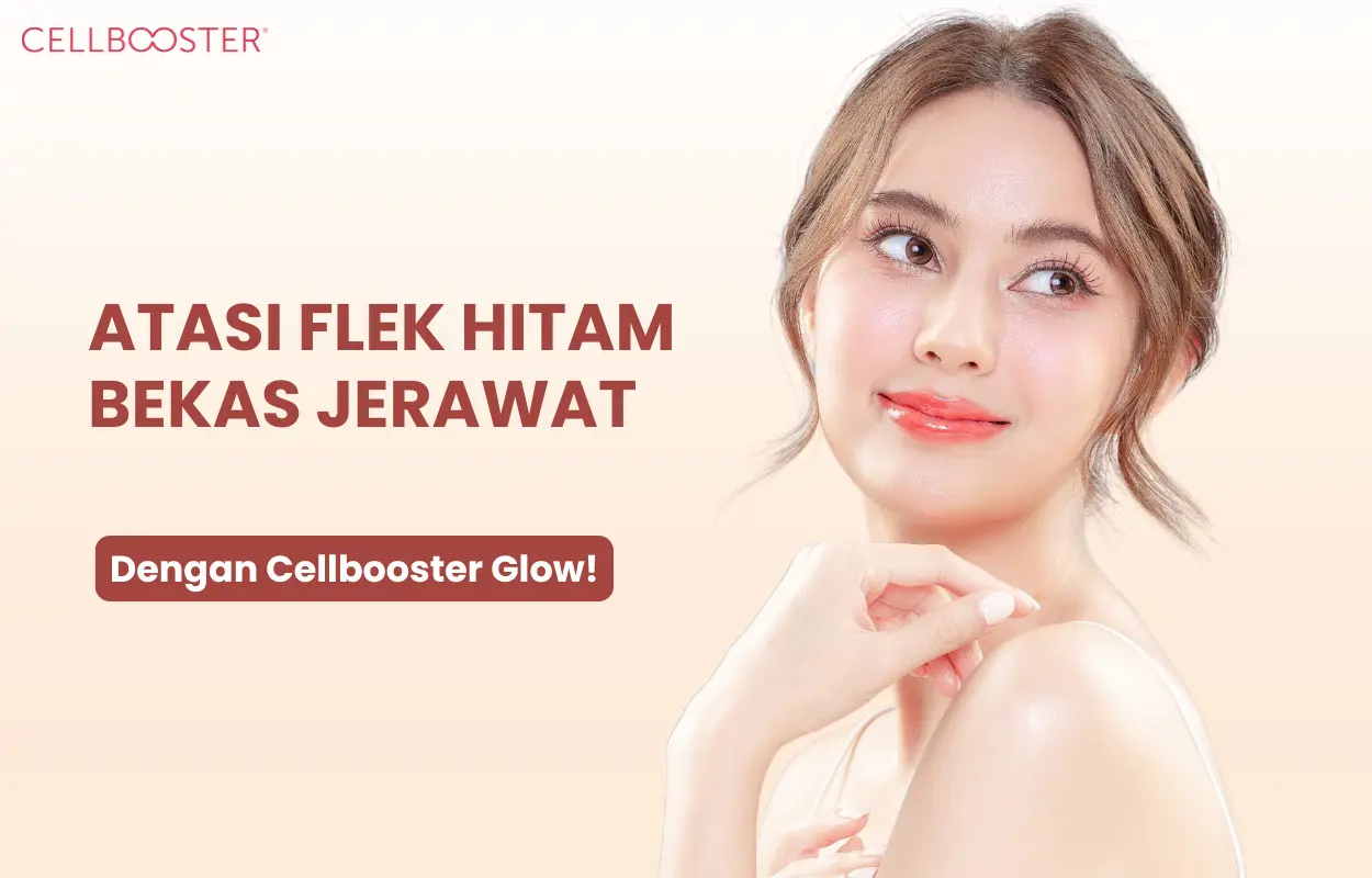 Cara Menghilangkan Flek Hitam Bekas Jerawat