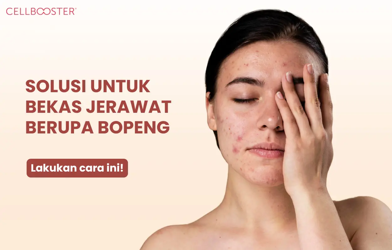 jerawat bopeng