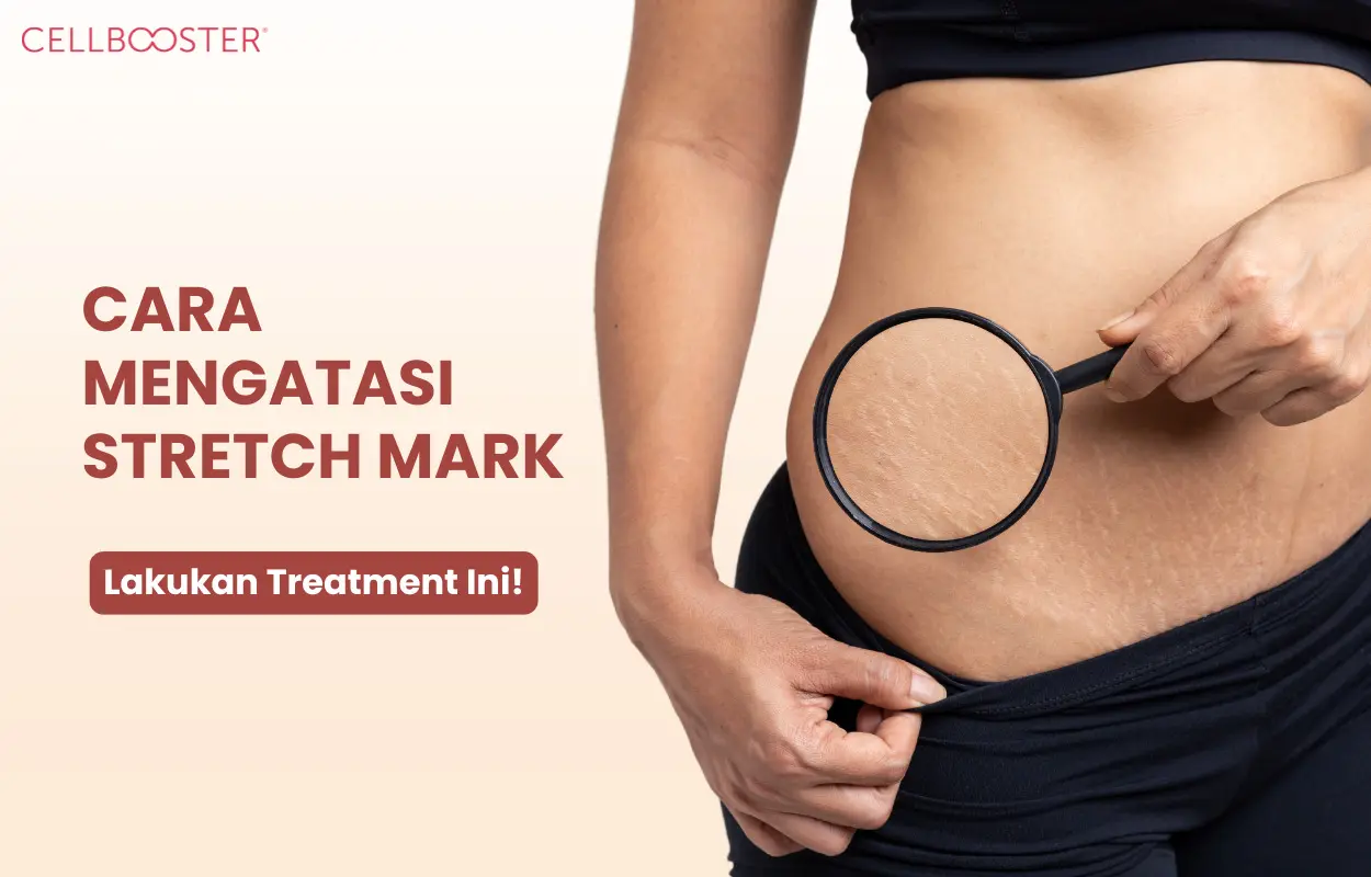 Cara Mengatasi Stretch
