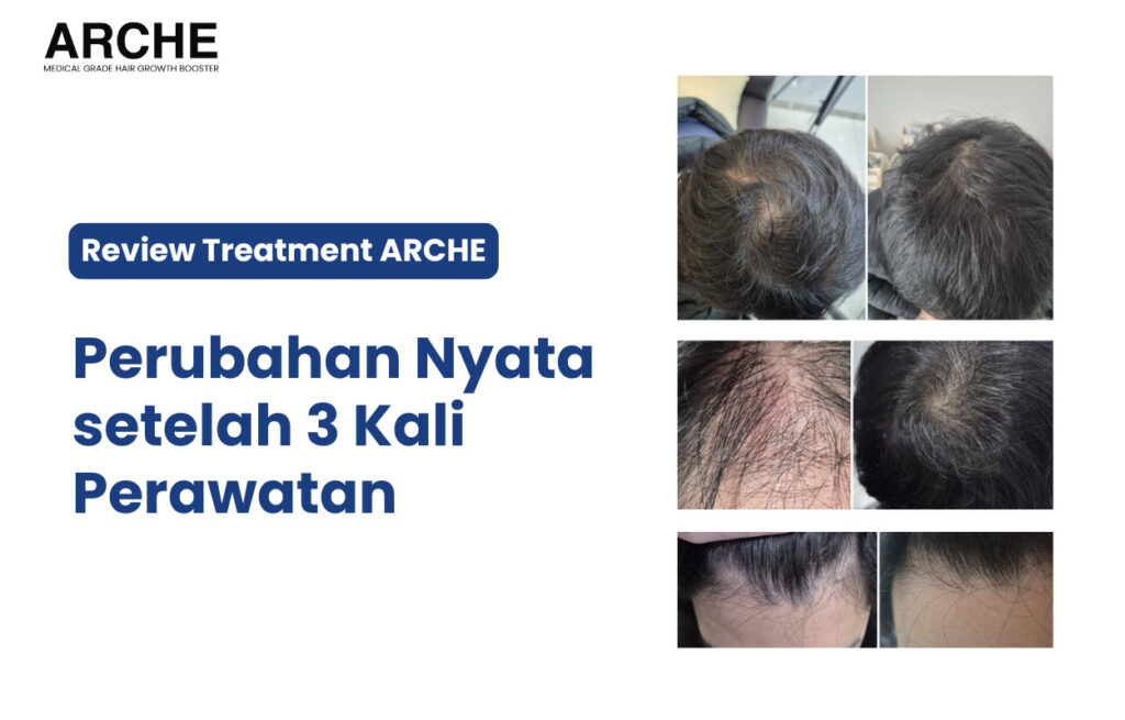 Perawatan Rambut Rontok ARCHE