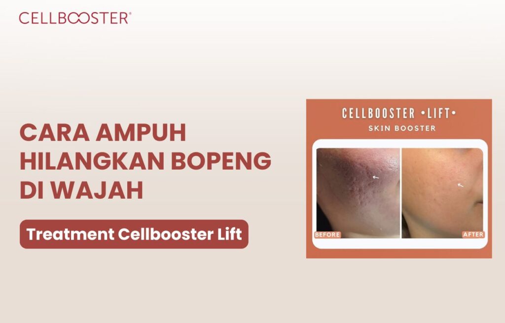 cara mengatasi bopeng secara alami