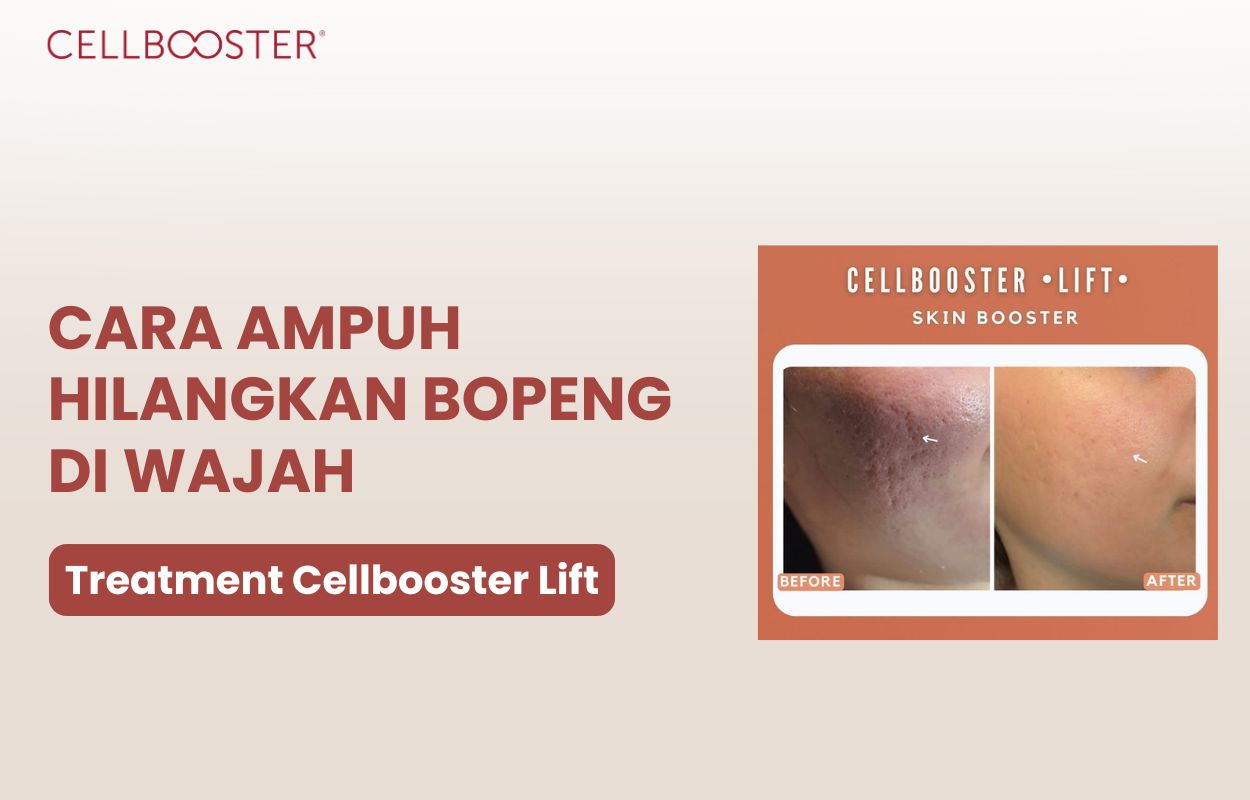 cara mengatasi bopeng secara alami