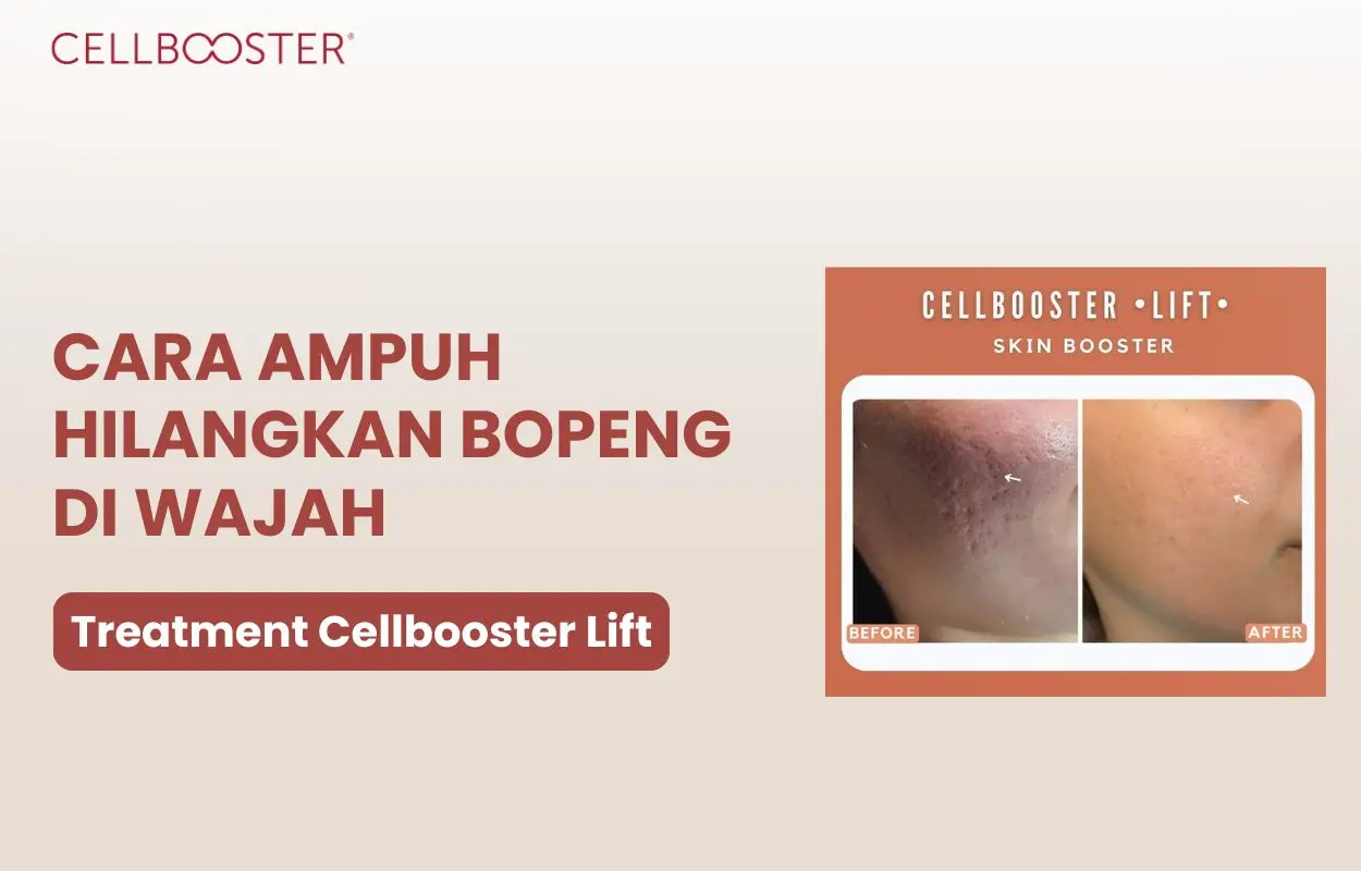 cara mengatasi bopeng secara alami