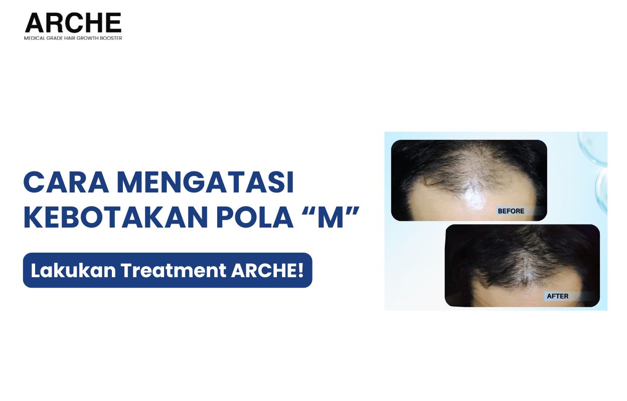 cara menumbuhkan rambut botak m