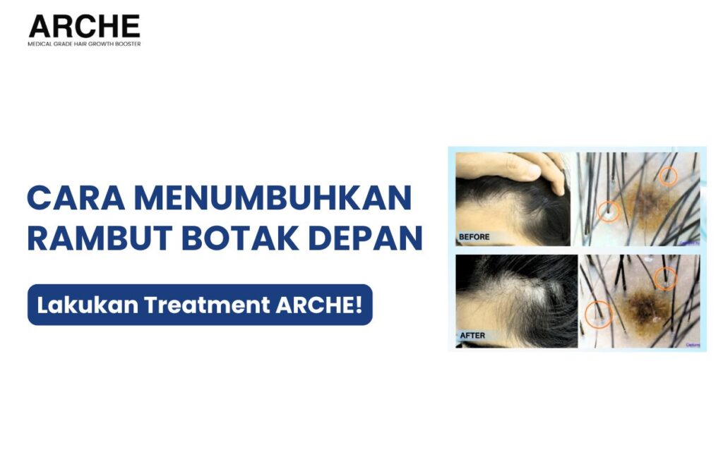 cara menumbuhkan rambut botak bagian depan