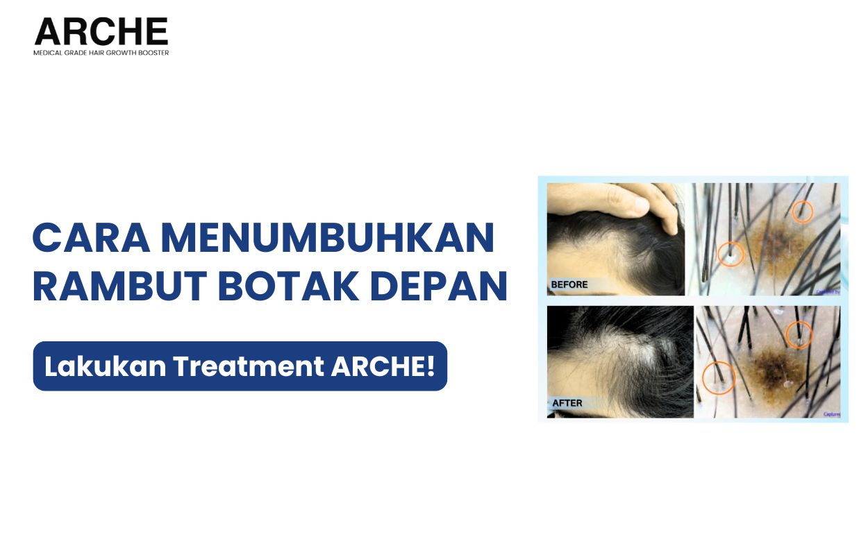 cara menumbuhkan rambut botak bagian depan