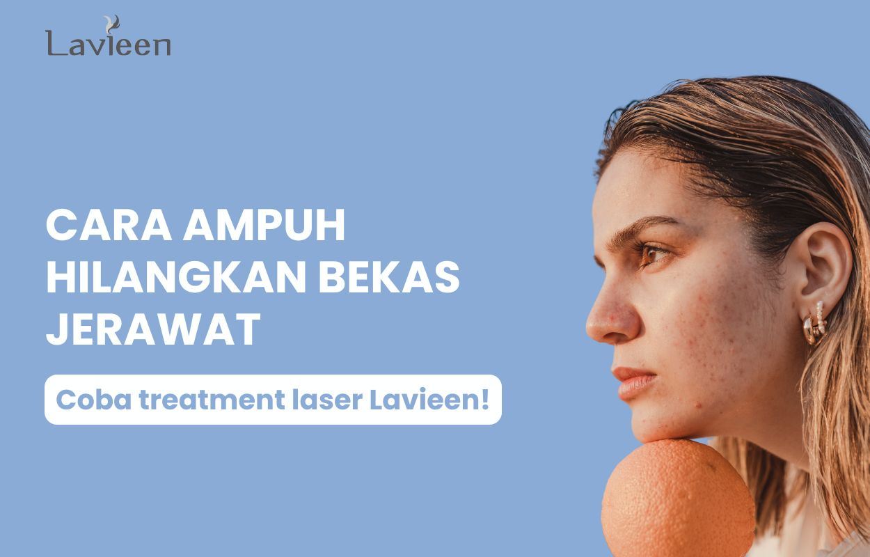cara menghilangkan bekas jerawat di pipi