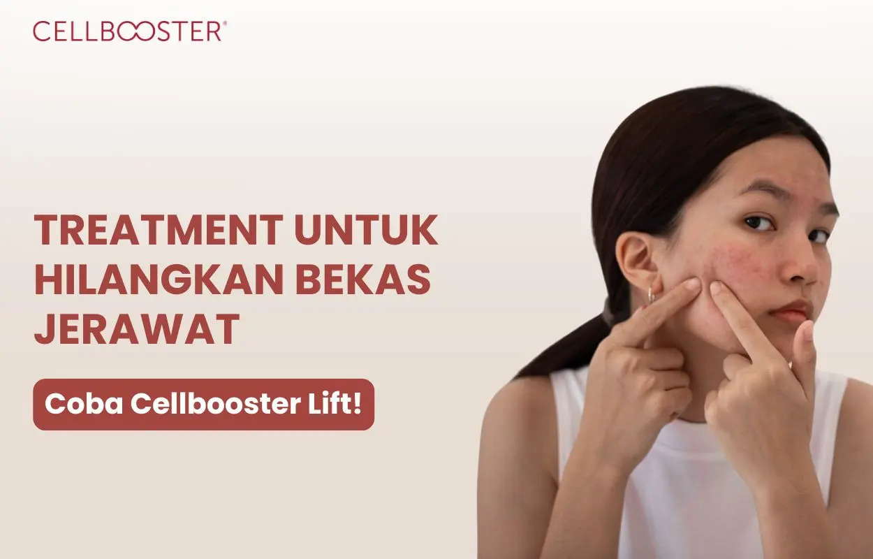 untuk menghilangkan bekas jerawat