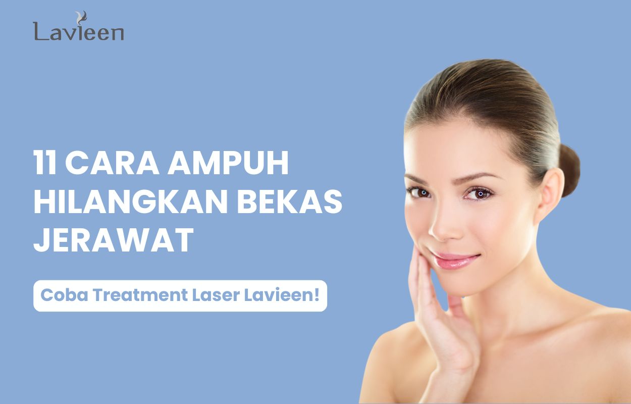cara mengatasi bekas jerawat