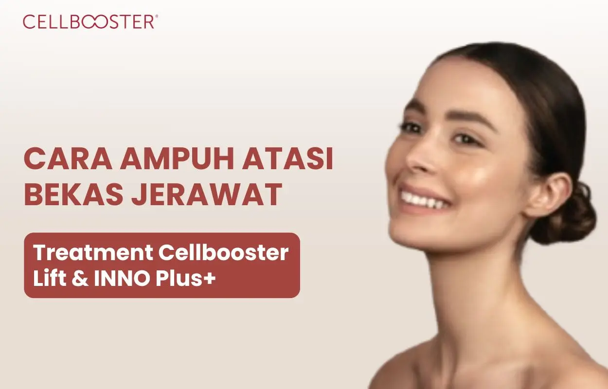 bekas jerawat