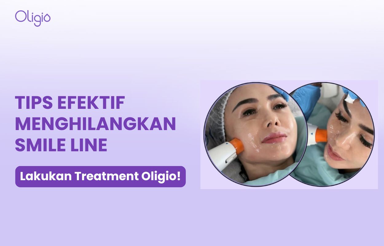 cara menghilangkan smile line di wajah