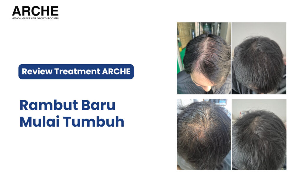 Solusi Ampuh untuk Masalah Rambut Rontok