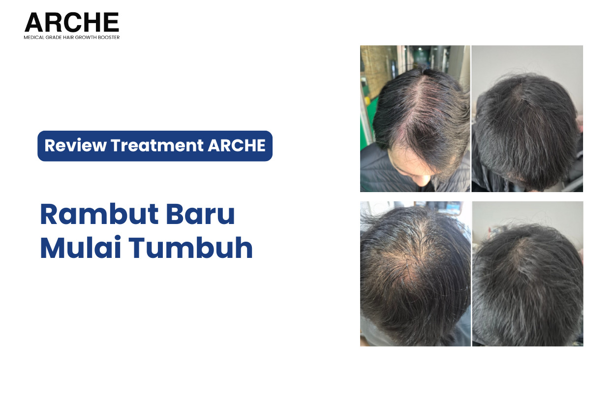 Solusi Ampuh untuk Masalah Rambut Rontok