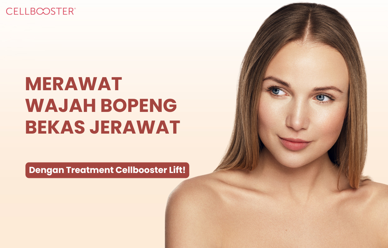 Cara Merawat Wajah Bopeng Bekas Jerawat