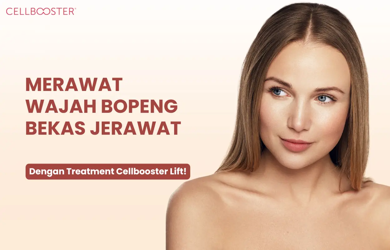 Cara Merawat Wajah Bopeng Bekas Jerawat