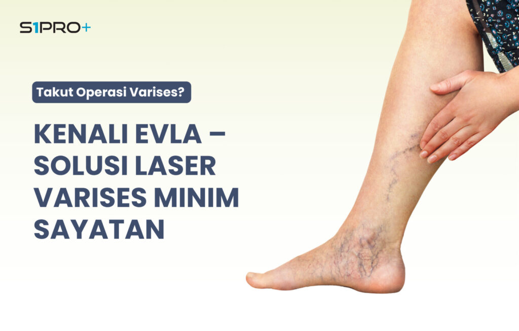 laser varises