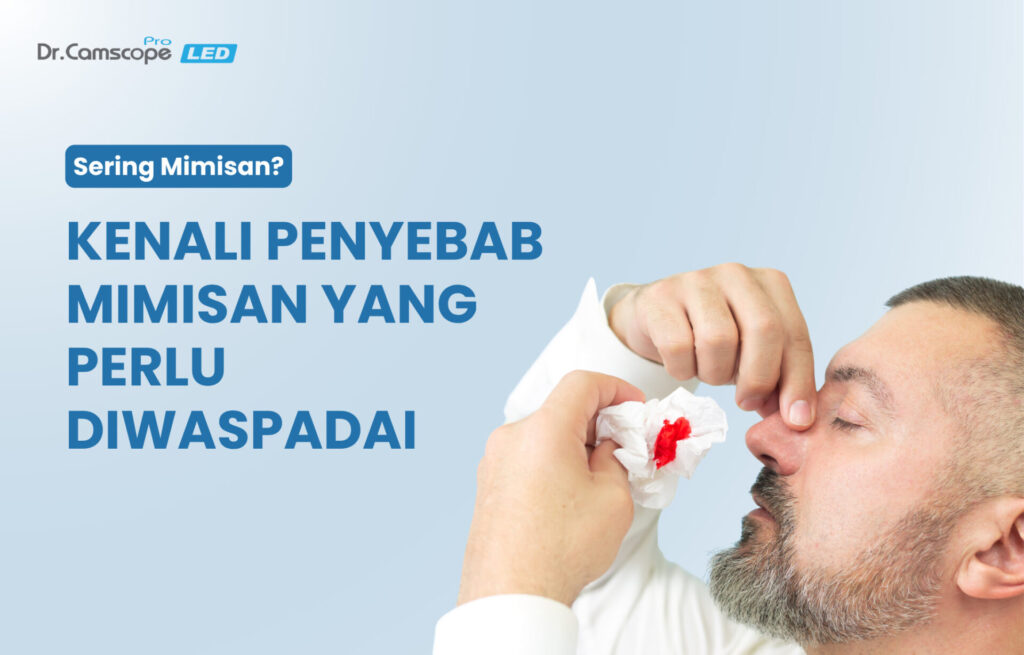 penyebab mimisan