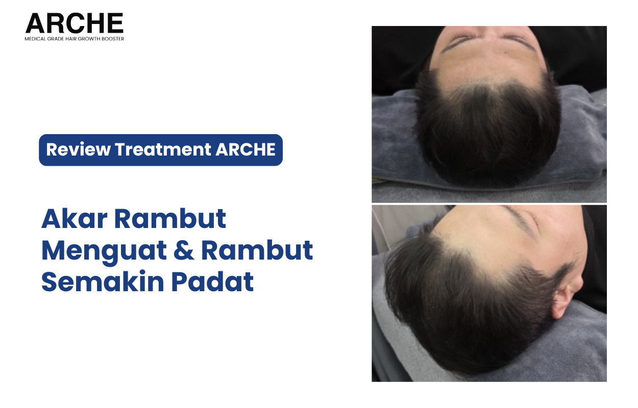 Perawatan Rambut Rontok ARCHE
