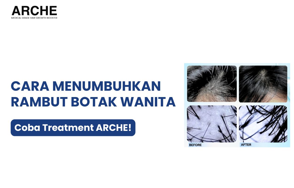 cara menumbuhkan rambut botak pada wanita