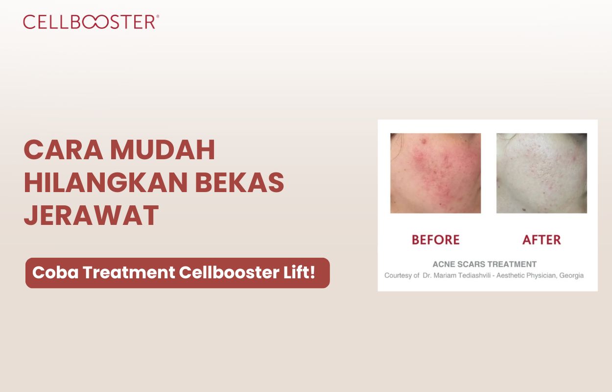cara menghilangkan bopeng dan bekas jerawat