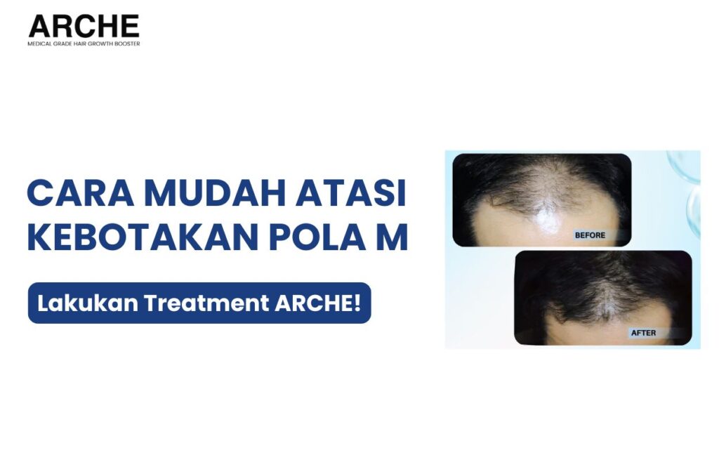 cara menumbuhkan rambut berbentuk m