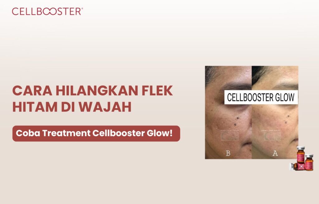 cara menghilangkan flek hitam di wajah yang membandel
