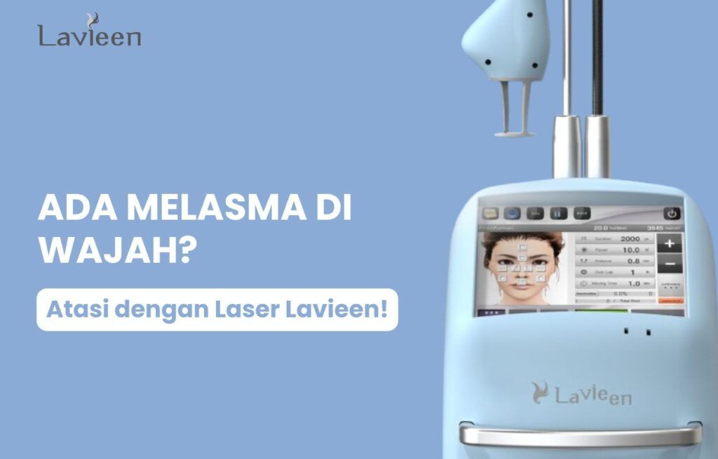 melasma pada wajah