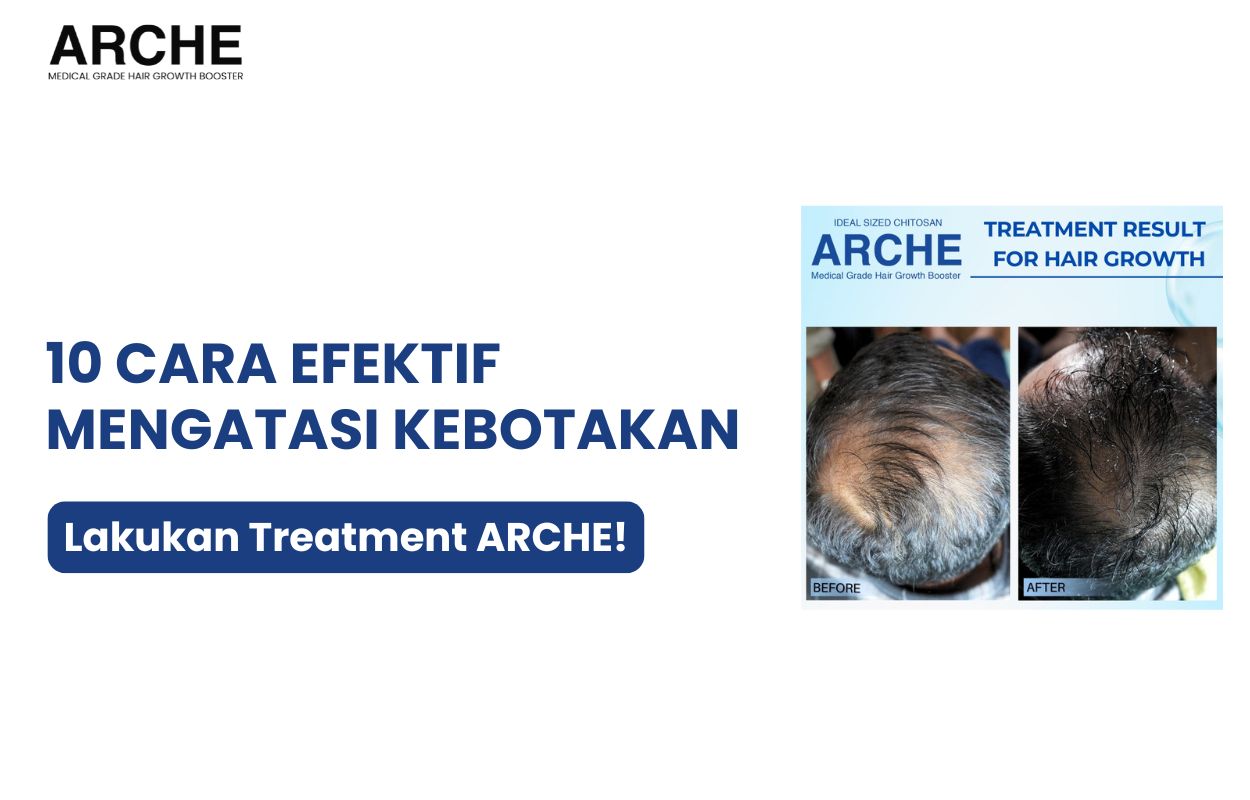 mengatasi rambut botak