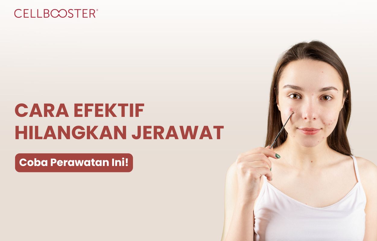 cara menghilangkan jerawat