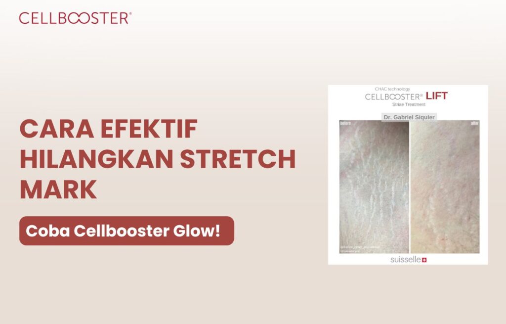 Cara menghilangkan stretch mark