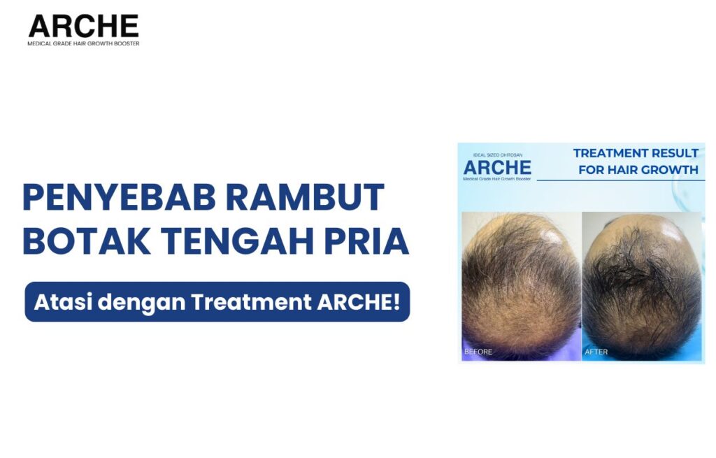 penyebab rambut botak tengah pada pria