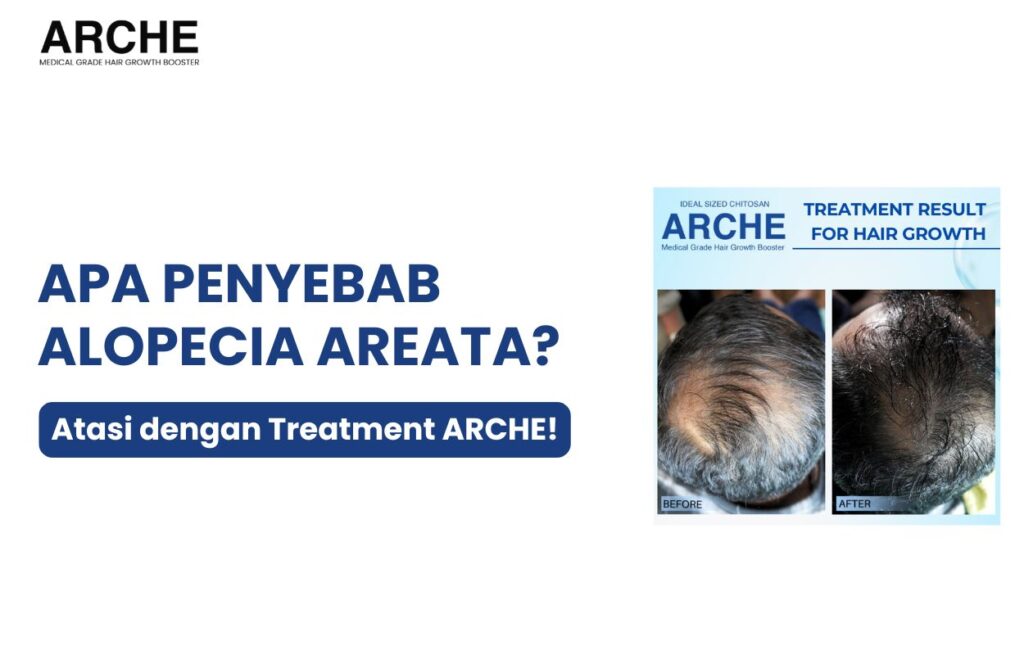 penyebab alopecia areata