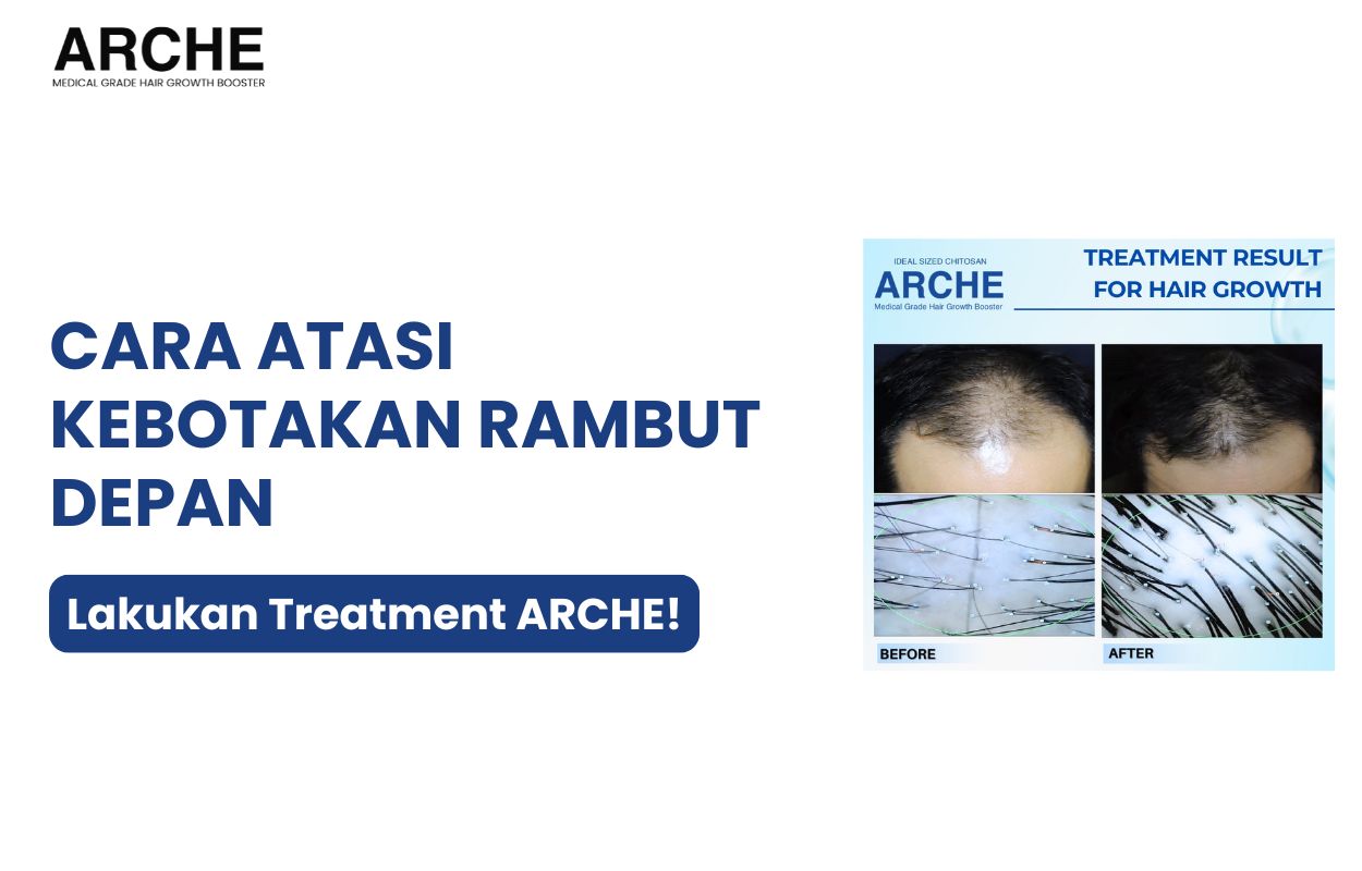 cara atasi kebotakan rambut depan