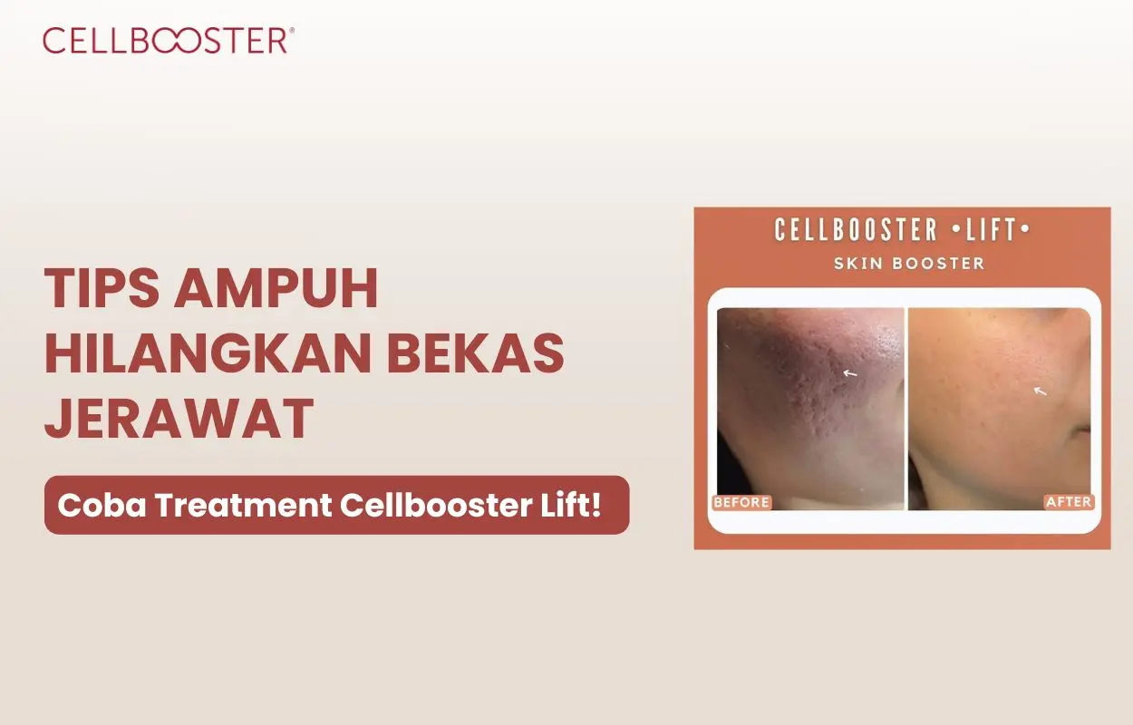 cara agar bekas jerawat cepat hilang