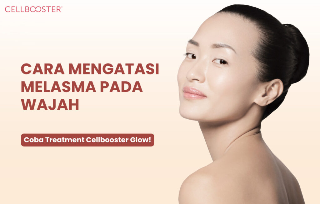 Cara Mengatasi Melasma pada Wajah