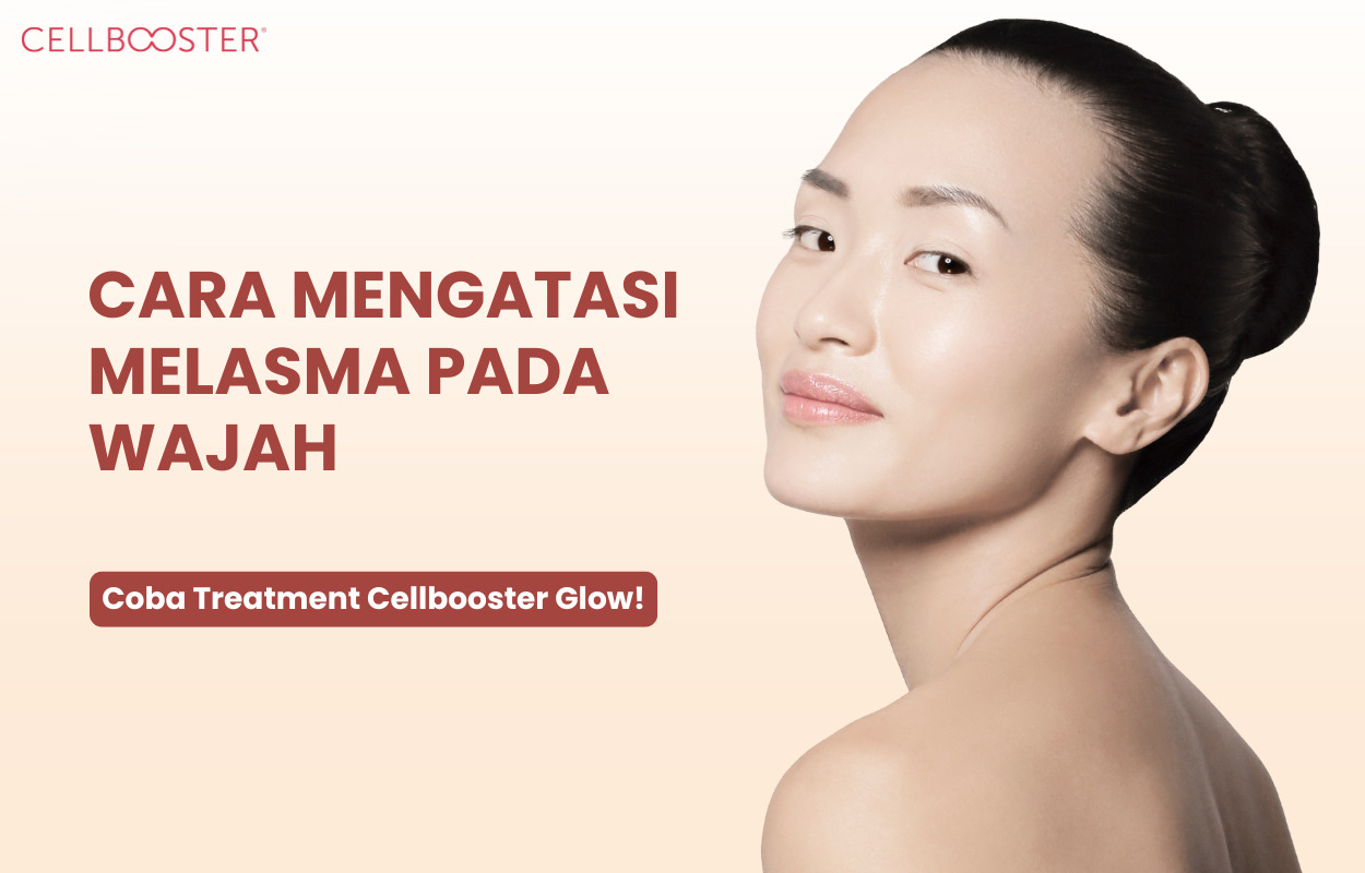 Cara Mengatasi Melasma pada Wajah