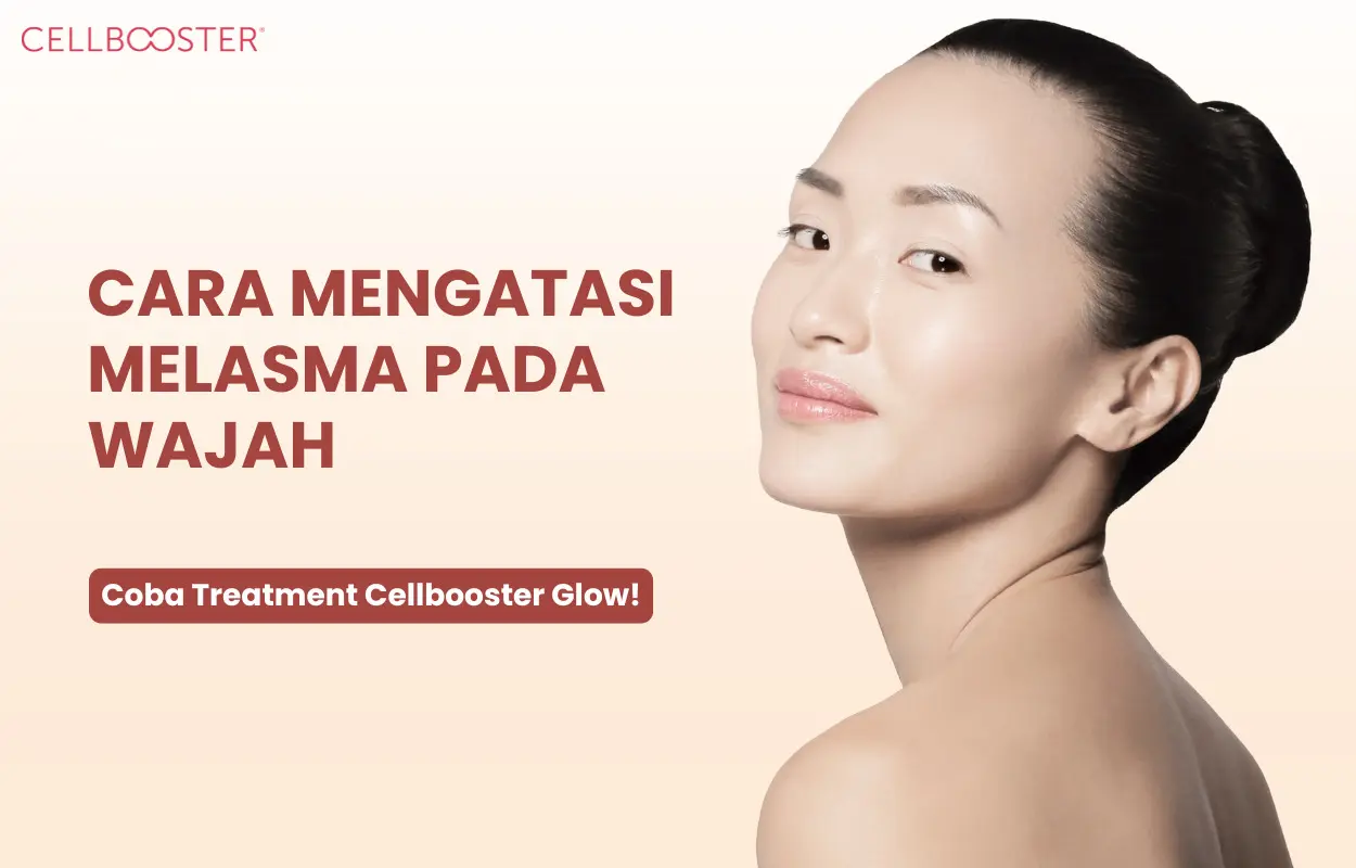 Cara Mengatasi Melasma pada Wajah