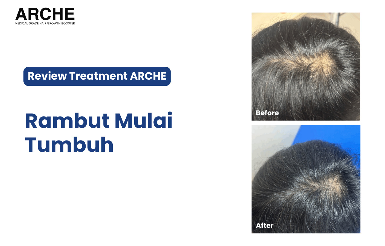 Rambut Rontok ARCHE