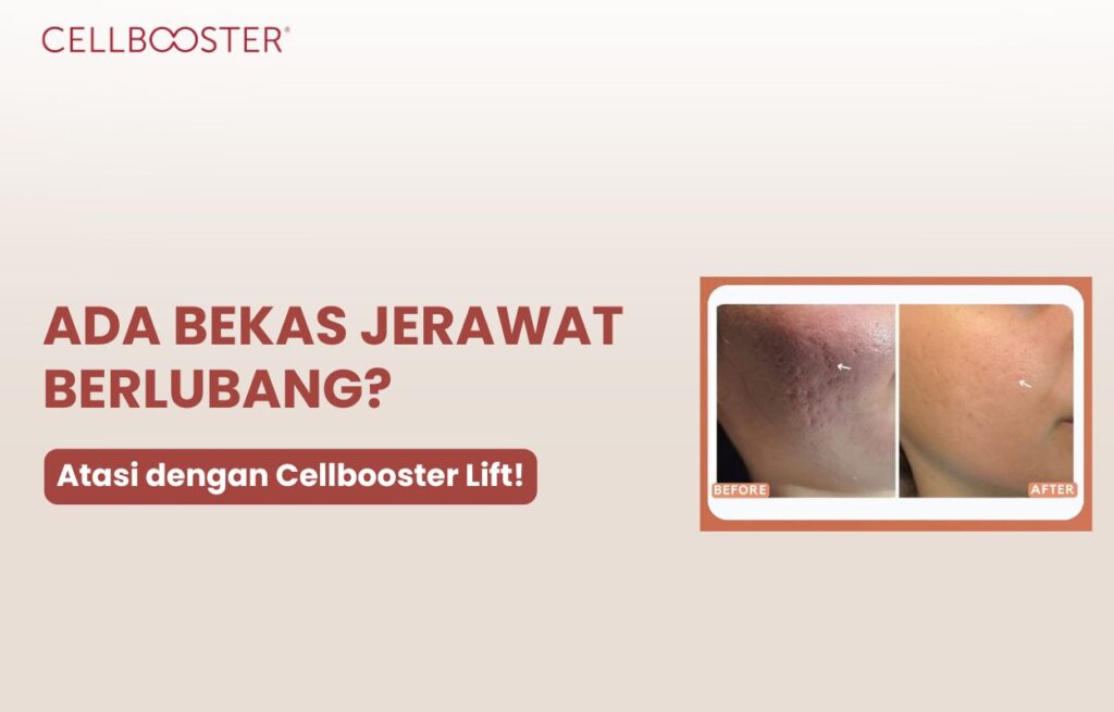 bekas jerawat berlubang