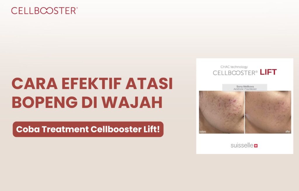 cara mengatasi wajah bopeng