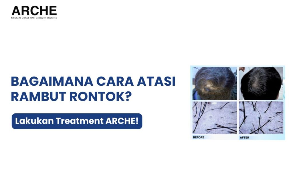 bagaimana mengatasi rambut rontok