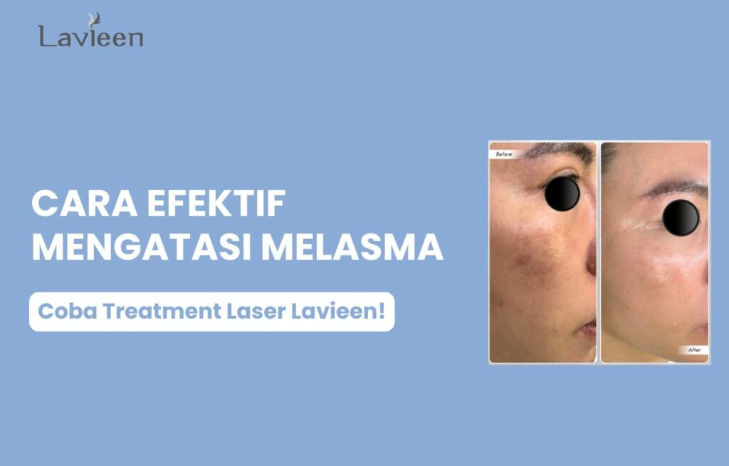 perawatan melasma