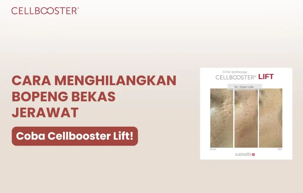 cara menghilangkan bekas jerawat bopeng