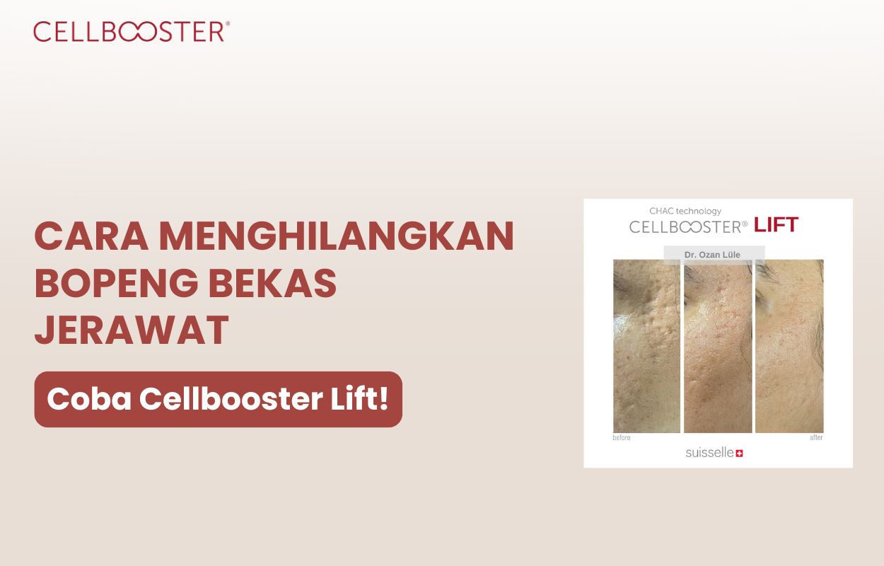 cara menghilangkan bekas jerawat bopeng