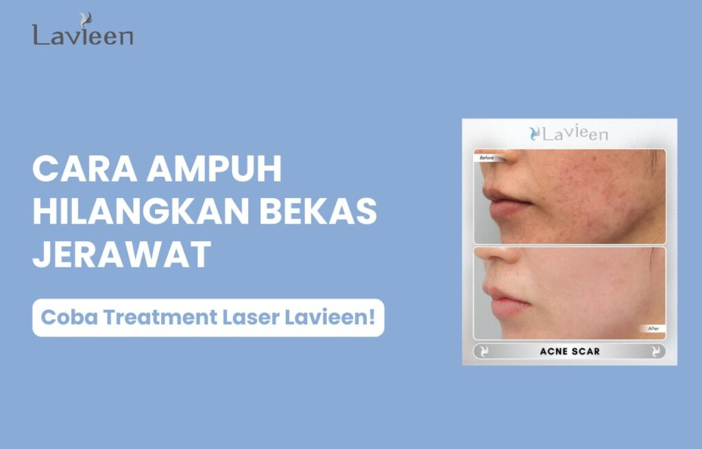 cara untuk menghilangkan bekas jerawat