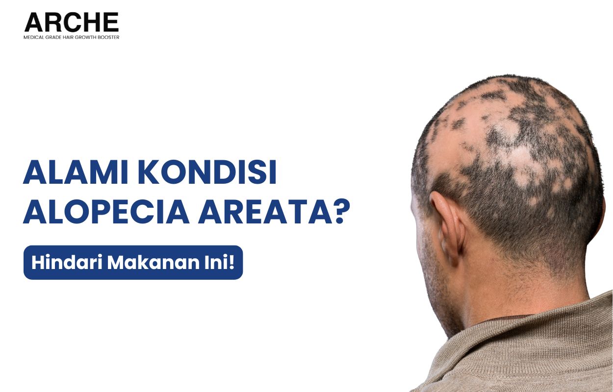 pantangan makanan alopecia areata