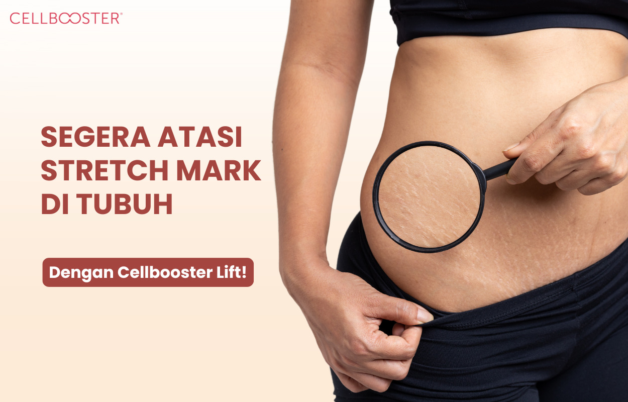 Kenapa Ada Stretch Mark